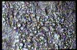 Lichen perforé amer.