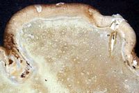 Polypore du bouleau. Cliquer pour agrandir l'image.