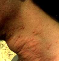 Processionnaire du pin. Peau urtiquee.